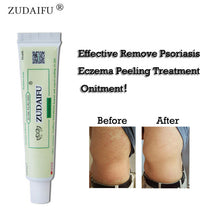 Load image into Gallery viewer, 1PC zudaifu Sulfur Soap add 1PC zudaifu Psoriis Cream Body Massage Patches Wholesale - EssentialBoutiques 